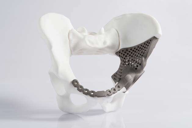 A Titanium custom implant